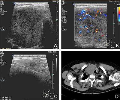 Coexistence of primary thyroid diffuse large B cell lymphoma and papillary thyroid carcinoma in a patient with Hashimoto’s thyroiditis: a case report and literature review